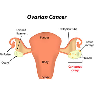 Cancerul ovarian. Simptome și factori de risc, Diagnosis of ovarian cancer